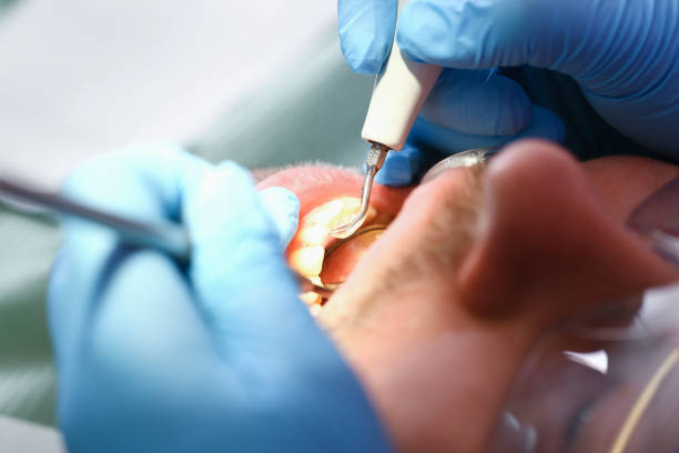 Best Broken or Cracked Tooth Emergency Dentist in Centerville, IN